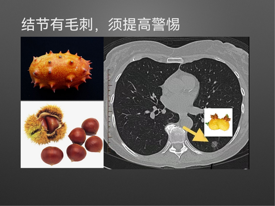 3_肺界网红-磨玻璃结节_QQ浏览器转格式_06.png